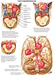 Giant Congenital Aneurysms