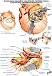 Frontotemporal Surgical Approach